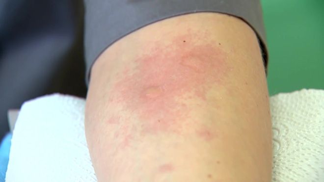 Аллергия на мандарины: фото сыпи у взрослых и детей, симптомы и лечение заболевания